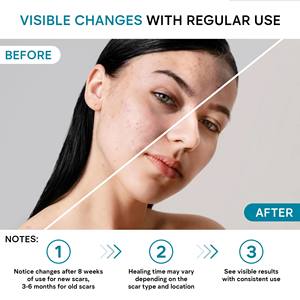 Removedor de cicatrices de acné de etiqueta privada Anti Vergeture Repair Productos de eliminación de cicatrices Crema de eliminación de cicatrices de acné fuerte y efectiva - Product Image 4