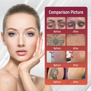 Portátil profissional Nd Yag Laser tatuagem remoção máquina carbono Peeling Laser para tatuagem Eraser - Product Image 6