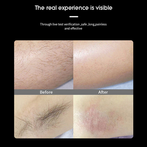 2025 tái phát minh 40% nhanh hơn 1600 <span class=keywords><strong>Watt</strong></span> <span class=keywords><strong>4</strong></span> Quattro <span class=keywords><strong>Diode</strong></span> 808 <span class=keywords><strong>Laser</strong></span> 755 1064 tẩy lông Salon Máy tẩy lông bằng <span class=keywords><strong>laser</strong></span> - Product Image 6