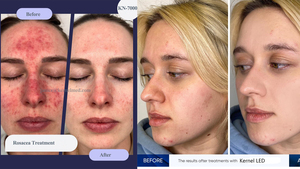 Đa bước sóng LED trị liệu hạt nhân dual-ánh sáng LED Spectrum trị liệu thiết bị màu đỏ, màu xanh, và màu xanh lá cây liệu pháp ánh sáng KN-7000A - Product Image 2