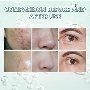 Máquina Facial Portátil 8 en 1 de Hidrodermoabrasión y Peeling Acuático, Equipo de Solución de Belleza para el Cuidado de la Piel - Product Image 6