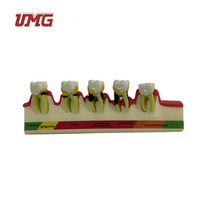 Tandheelkundige Studiemodellen Classificatiemodel Parodontitis - Product Image 2