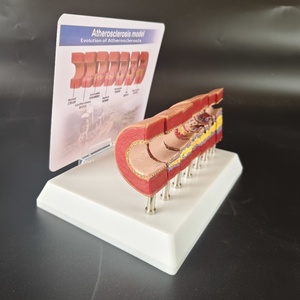 Model Anatomi Aterosklerosis Manusia, Penyumbatan Patologis Intima, Stenosis, Akumulasi Lemak, Jantung Lansia Paruh Baya - Product Image 2