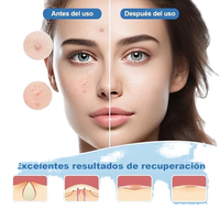 Patch Hydrocolloïde Coréen Anti-Acné Couvrant les Boutons, Hydratant et Invisible, Autocollant Anti-Imperfections au Collagène Anti-Âge, Marque Privée