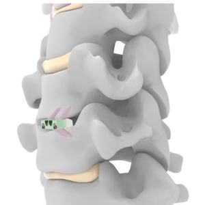 Titanium Zero Profile <strong>Cervical</strong> <strong>Peek</strong> <strong>Cage</strong> with Screw Stand Alone <strong>Spinal</strong> Stabilization Implant for Orthopedic Surgery - Product Image 1