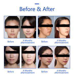 เครื่องสลายไขมันแบบตั้งโต๊ะ Peninsula Gold Micro-Sculpture ABS ช่วยสลายไขมันอย่างปลอดภัย ปรับรูปร่าง กระชับผิว เสริมความงาม - Product Image 5