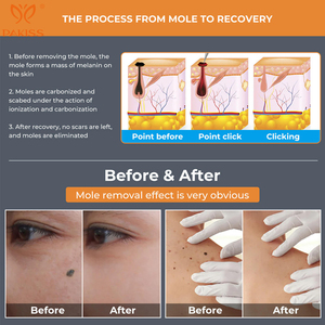 PAKISS di alta qualità portatile elettrico pelle <span class=keywords><strong>Tag</strong></span> penna ricaricabile lentiggine verruche puntino talpa rimozione del tatuaggio per uso domestico - Product Image 6