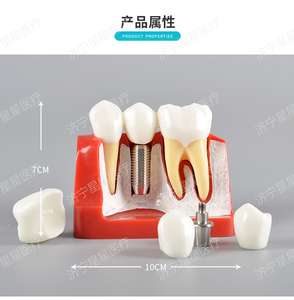 4 fois seul implant dentaire d'analyse modèle comparer avec pont logo OEM - Product Image 2