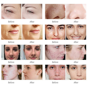 Máquina de Belleza Profesional Portátil, Controlador de Corte Láser de CO2 y Oxígeno, Pantalla de Láser Fraccional para la Piel, Acero Inoxidable 2 en 1 - Product Image 2