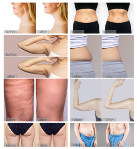 3 tay cầm 2.45GHz ABS đứng máy giảm béo cơ thể màn hình lớn nâng mặt giảm mỡ sử dụng thương mại 2025 - Product Image 6