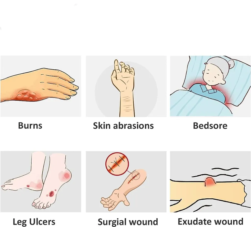 Perawatan luka penyembuhan lembab penyerap medis balutan ION Alginate perak Ag steril teknologi tinggi