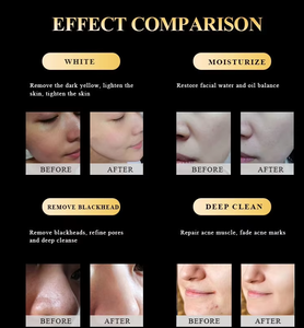 Dispositivo Facial Profesional de Hidrodermoabrasión de Alta Presión, <span class=keywords><strong>Peeling</strong></span> Físico sin Succión, Máquina de Oxígeno y Agua para Clínica - Product Image 3
