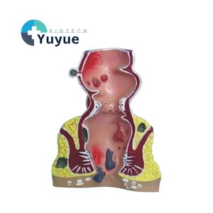 Modello Anatomico di Emorroidi Anorettali Umane con Malattie Rettali Comuni per l'Insegnamento in Gastroenterologia - Product Image 1