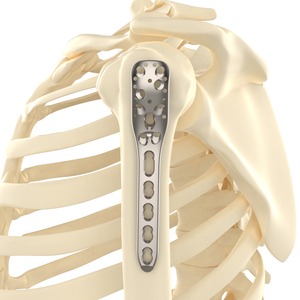 Implantes Ortopédicos CANWELL, Placa de Bloqueo de Titanio para Húmero <span class=keywords><strong>Proximal</strong></span>, para Cirugía de Fracturas Óseas, Consumibles para Quirófano - Product Image 1