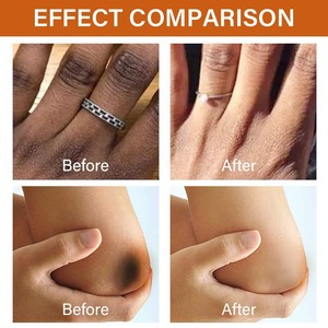 Suero de blanqueamiento rápido para nudillos oscuros OEM, correctores de pigmentación, codos para nudillos de mano, suero removedor de <span class=keywords><strong>manchas</strong></span> intensas para rodilla - Product Image 6