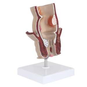Medizinisches Lehr modell Rektales Pathologie modell für die Ausbildung von Prokto logie und Anatomie - Product Image 5