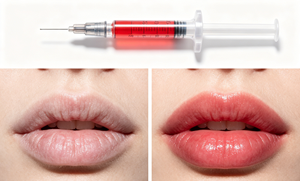 โรงงานขายส่งฟิลเลอร์ไฮยาลูโรนิกแอซิดแบบเชื่อมโยง 1 มล. สำหรับฉีดเติมเต็มริมฝีปาก - Product Image 3