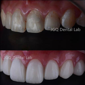 الأسنان إيماكس زركونيا تبييض الأسنان إيماكس وزركونيا القشرة مختبر الأسنان رخيصة الثمن - Product Image 5