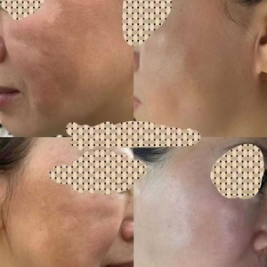Tratamiento Instantáneo para Melasma y Hiperpigmentación, Peeling Anti-Melasma, Cuidado de la Piel, Set de 4 Piezas - Product Image 3