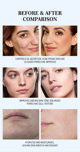 Sérum de soin de la peau de marque privée arbre à thé traitement de l'acné sérum <span class=keywords><strong>pour</strong></span> le visage réparation des boutons avec élimination des points noirs propriétés hydratantes - Product Image 6