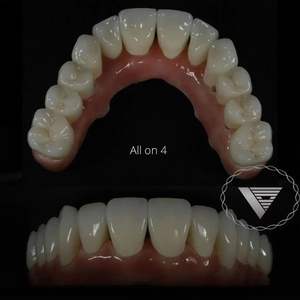 MIIYEN 1400Mpa HT Shaded <span class=keywords><strong>CAD</strong></span> <span class=keywords><strong>CAM</strong></span> <span class=keywords><strong>Dental</strong></span> <span class=keywords><strong>Zirconia</strong></span> materiali odontotecnico blocco di <span class=keywords><strong>Zirconia</strong></span> dentale - Product Image 6