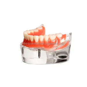 Modelo de implante base transparente con sobre dentadura, suministros ducacionales, modelo de implante con 2 implantes