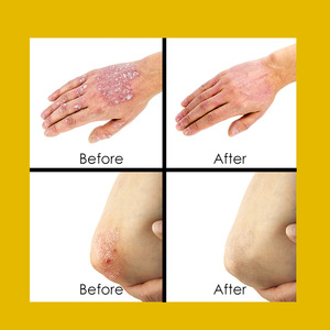 Crème de soin externe pour la peau 20g avec différents ingrédients à base de plantes pour l'eczéma et le psoriasis - Product Image 4