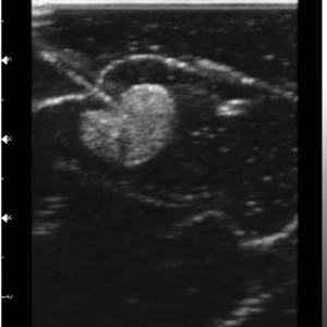 बी-अल्ट्रासाउंड प्रशिक्षण थायरॉयड मॉड्यूल अल्ट्रासाउंड-गाइडेड थायरॉयड बायोप्सी मॉडल - Product Image 5