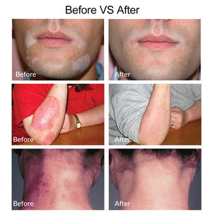 Dispositivo <span class=keywords><strong>de</strong></span> Terapia <span class=keywords><strong>de</strong></span> Luz UVB <span class=keywords><strong>de</strong></span> 308nm para Uso Doméstico para el Tratamiento del Eccema, Vitíligo y Psoriasis con Resultados Rápidos, Terapia Cutánea Específica - Product Image 5