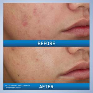 Crème Nettoyante Moussante Anti-Acné en Gros 10% Peroxyde de Benzoyle Nettoyant Doux Visage et Corps avec Acide Hyaluronique et Niacinamide - Product Image 4