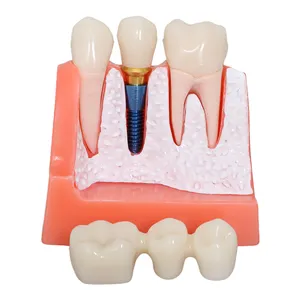 Dental Teaching Model 4 Times Dental Model Teeth Implant Model Teaching Resources Of Mandibular Teeth Teaching Mod