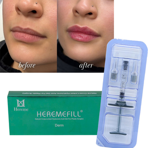 Acide hyaluronique réticulé, gel HA injectable pour <span class=keywords><strong>comblement</strong></span> et augmentation des lèvres, et traitement des <span class=keywords><strong>rides</strong></span> des lèvres - Product Image 1
