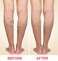 Appareil d'ablation laser endoveineuse EVLT EVLA pour la chirurgie des varices, traitement au laser 980nm1470nm pour les jambes, varices