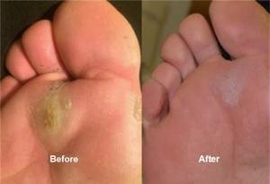 Láser de Diodo Dimed Berylas GaAlAs 1064nm/980nm para <span class=keywords><strong>Tratamiento</strong></span> de <span class=keywords><strong>Hongos</strong></span> en las <span class=keywords><strong>Uñas</strong></span> y Equipo de Fisioterapia de Rehabilitación - Product Image 4