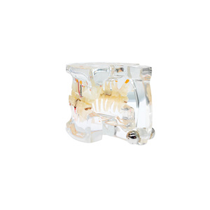 Modelo patológico de boca completa con 32 dientes; modelo dental patológico completo; modelo dental desmontable; restauración de implantes - Product Image 4
