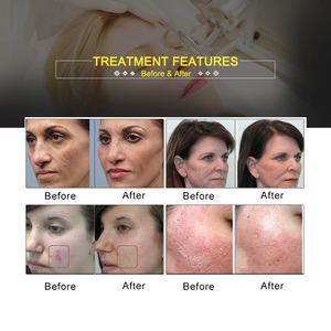 Máquina <span class=keywords><strong>de</strong></span> Láser Fraccional <span class=keywords><strong>de</strong></span> CO2, Precio Más Bajo, Máquina <span class=keywords><strong>de</strong></span> Rejuvenecimiento Cutáneo, Láser <span class=keywords><strong>de</strong></span> CO2 para Cicatrices <span class=keywords><strong>de</strong></span> Acné, Medicina Estética con CO2 Fraccionado - Product Image 5