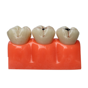 Modelo Anatómico de Caries Dental de Resina, Modelo de Dientes para el Cuidado Bucal, para Educación en Ciencias Médicas - Product Image 1