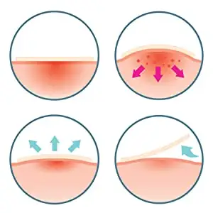 OEM Wholesale Skin Blemish Treatment With Hydrocolloid Blemish Acne Pimple Patch