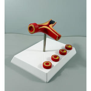 Modèle de blocage des vaisseaux sanguins en anatomie humaine LYA-002, concentration sanguine, <span class=keywords><strong>pathologie</strong></span> des graisses, atherosclérose, <span class=keywords><strong>pathologie</strong></span> <span class=keywords><strong>vasculaire</strong></span> - Product Image 3