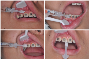Gel Anticaries Seavue (Transparente en Envase de Plástico) 1ml, Certificado ISO 13485, Previene las Caries Dentales, Mejora la Erosión Ácida de los Dientes - Product Image 5