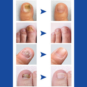 Solución líquida reparadora de <span class=keywords><strong>uñas</strong></span> de 10ml para limpiar, blanquear, nutrir y tratar hongos <span class=keywords><strong>en</strong></span> <span class=keywords><strong>las</strong></span> <span class=keywords><strong>uñas</strong></span> de los dedos de los pies - Product Image 2