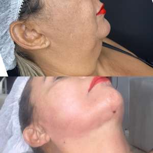 ポータブル医療用エンドーザーフェイスリフティングおよびスリミングマシン980/1470ダイオードレーザー脂肪分解非外科用脂肪吸引 - Product Image 5