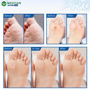 Plester Penghilang Kapalan Kaki Clavus dengan Asam Salisilat Bersertifikat CE untuk Kapalan Jari Kaki 6-Pak Plester Pereda Nyeri Meditan - Product Image 4