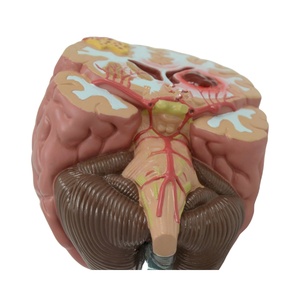 Modelos anatómicos cerebrales patológicos Hemorragia cerebral, tumores y modelo de enfermedad cerebral por accidente cerebrovascular - Product Image 2