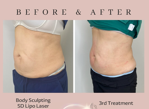 2025 Non-Surgical Lipolysis Machine Slimming Equipment 5D Lipolaser Deoxycholic Fat Dissolvent Inch Loss <strong>Decrease</strong> <strong>Cellulite</strong> - Product Image 3