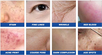 Laser fractionnel au CO2 médical CE coréen pour le corps / Équipement de beauté au laser CO2 / Machine laser de blanchiment de la peau pour la beauté