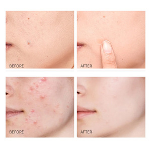 Parches Hidrocoloides para Acné XC <span class=keywords><strong>Mighty</strong></span>, Cuidado de la Piel, Cómodos, Invisibles, con Forma de Estrella y Corazón Holográficos, 5g, Color y Tamaño Personalizables - Product Image 4