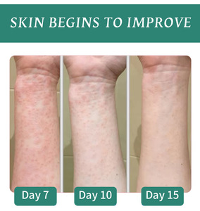 Crème <span class=keywords><strong>naturelle</strong></span> à base de plantes chinoises pour l'eczéma OEM/ODM – Crème anti-démangeaisons et anti-infections fongiques – Meilleure vente - Product Image 5