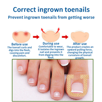Autocollants pour ongles en forme de U, élastiques, beiges, pour les ongles incarnés |   Patchs orthopédiques ajustables sans colle pour manucure