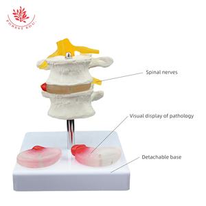 Modèle de lésion de la colonne vertébrale lombaire FRT038 modèle de pathologie vertébrale à deux segments du disque lombaire enseignement des étudiants en médecine - Product Image 4